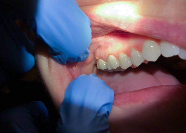 Best Urgent Tooth Repair  in Centerville, SC